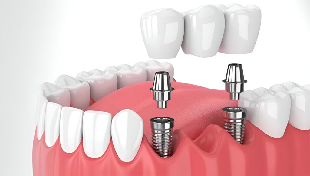 3D illustration of dental implants with abutments and crowns, showing how implant treatment works for patients wondering ‘Will dental implants hurt?’