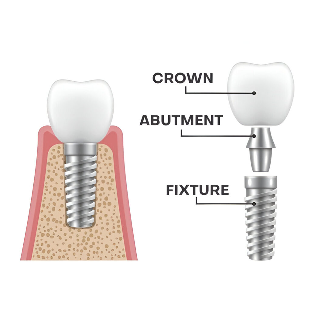 Side-view medical diagram of a dental implant showing the crown, abutment, and fixture to help explain the implant procedure and answer ‘Will dental implants hurt?