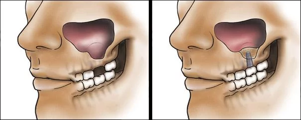 Illustration showing sinus lift bone grafting to create space for a dental implant in the upper jaw.